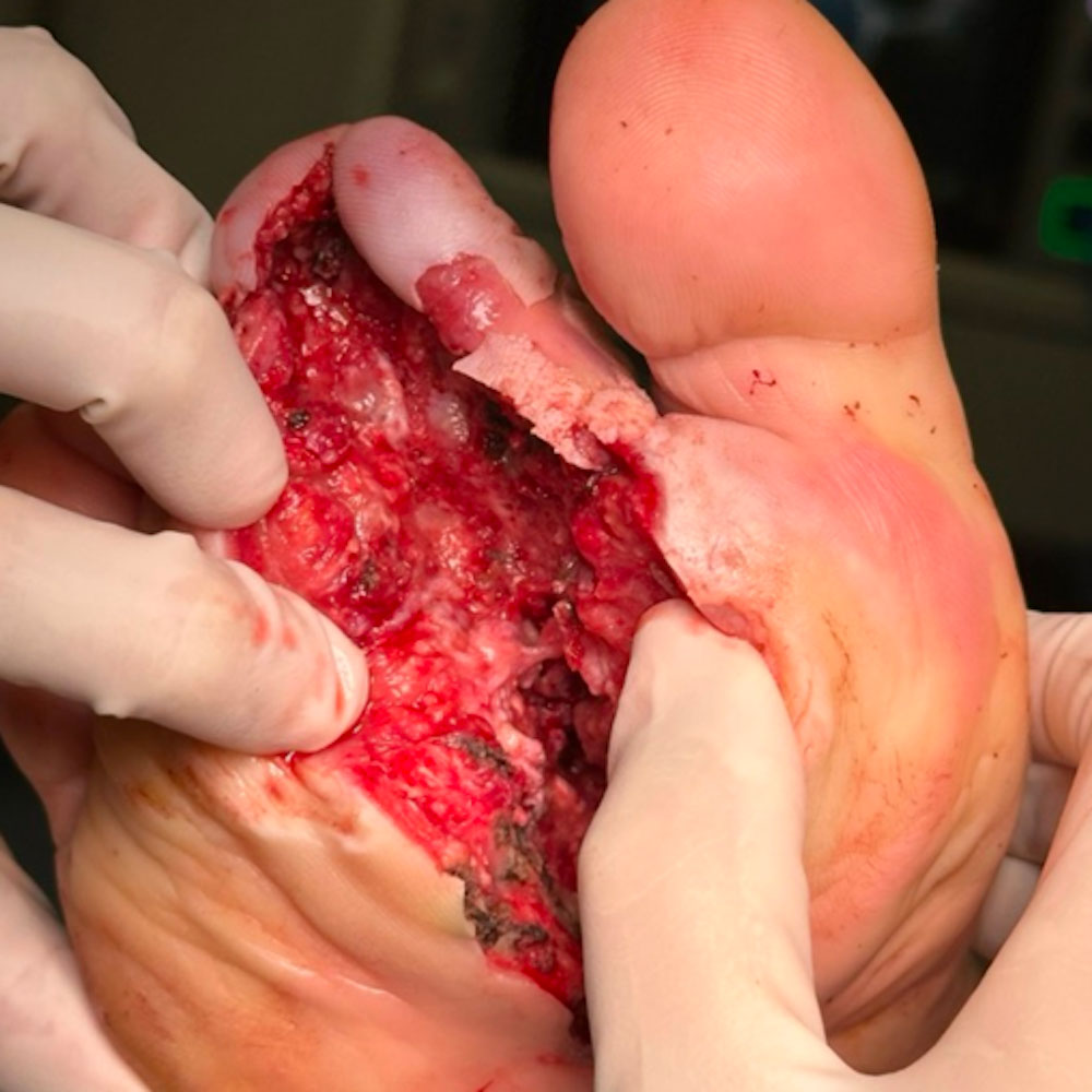 Second Ray Resection for Extensive Diabetic Foot Osteomyelitis procedure image