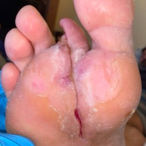 Second Ray Resection for Extensive Diabetic Foot Osteomyelitis outcome image