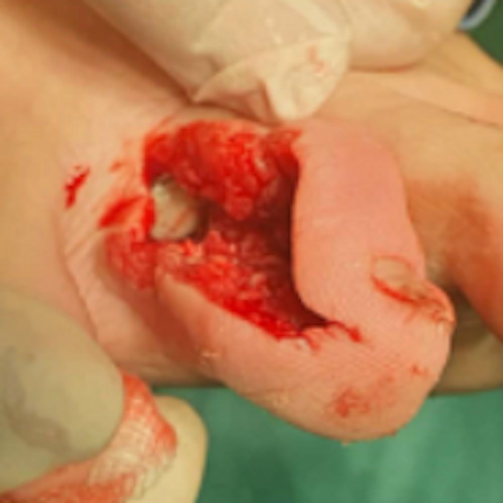 Soft-Tissue Envelope Preservation After Fifth Toe Phalangeal Resection before image