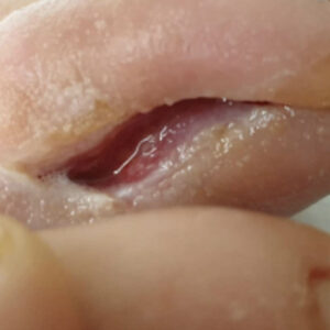 Soft-Tissue Envelope Preservation After Fifth Toe Phalangeal Resection procedure image