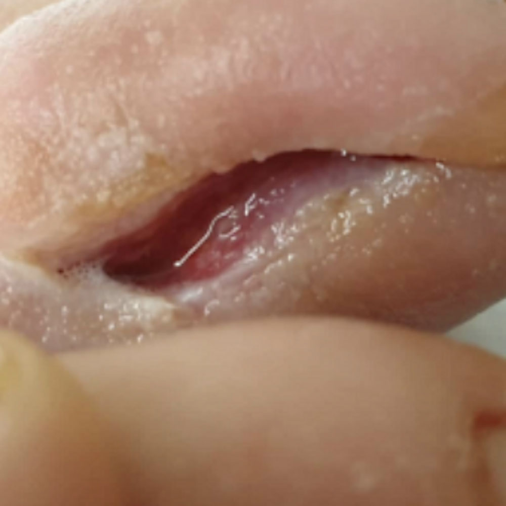 Soft-Tissue Envelope Preservation After Fifth Toe Phalangeal Resection procedure image
