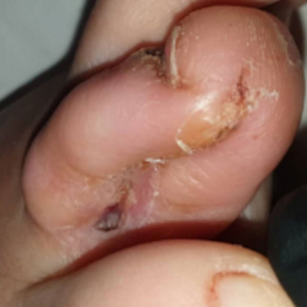 Soft-Tissue Envelope Preservation After Fifth Toe Phalangeal Resection outcome image