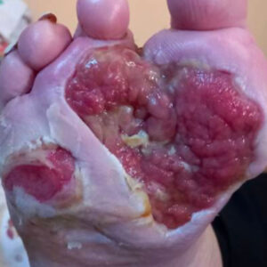 Limb-Sparing Surgery for Multidrug-Resistant Diabetic Foot Osteomyelitis before image