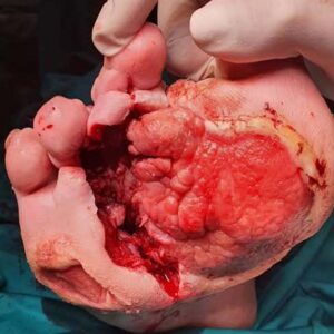 Limb-Sparing Surgery for Multidrug-Resistant Diabetic Foot Osteomyelitis procedure image