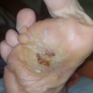 Limb-Sparing Surgery for Multidrug-Resistant Diabetic Foot Osteomyelitis outcome image