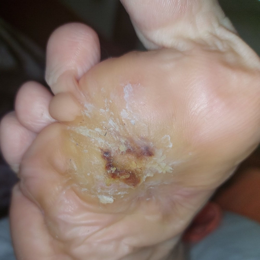 Limb-Sparing Surgery for Multidrug-Resistant Diabetic Foot Osteomyelitis outcome image