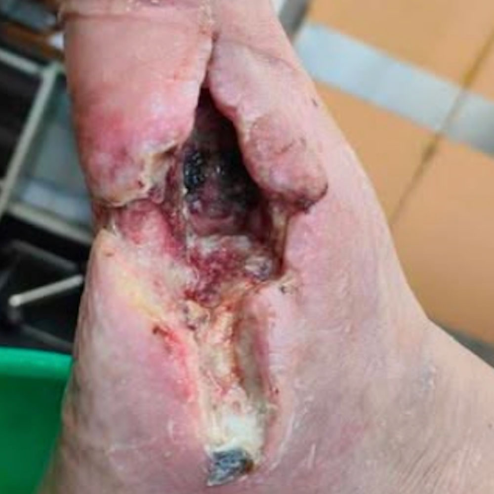 Tarsal Osteomyelitis Following Previous Partial Foot Amputation before image