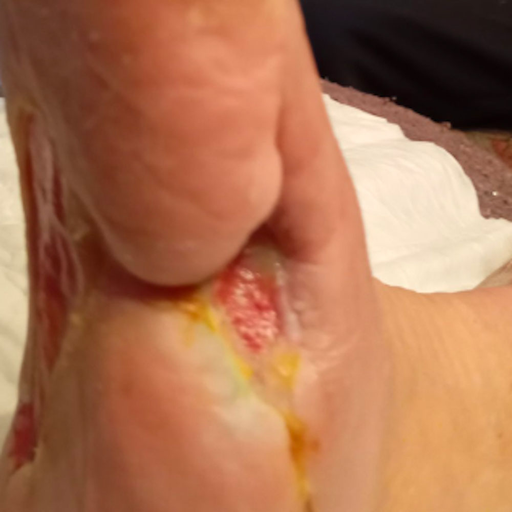 Tarsal Osteomyelitis Following Previous Partial Foot Amputation procedure image