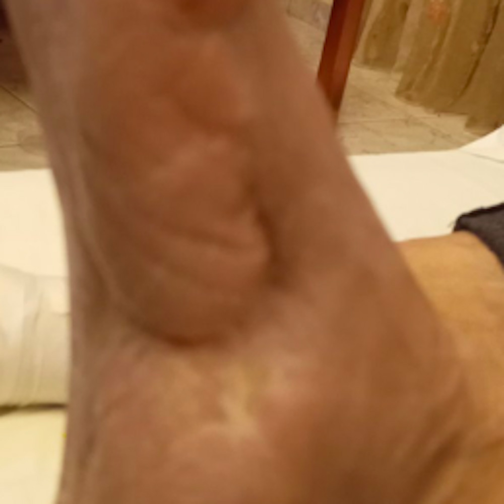 Tarsal Osteomyelitis Following Previous Partial Foot Amputation outcome image