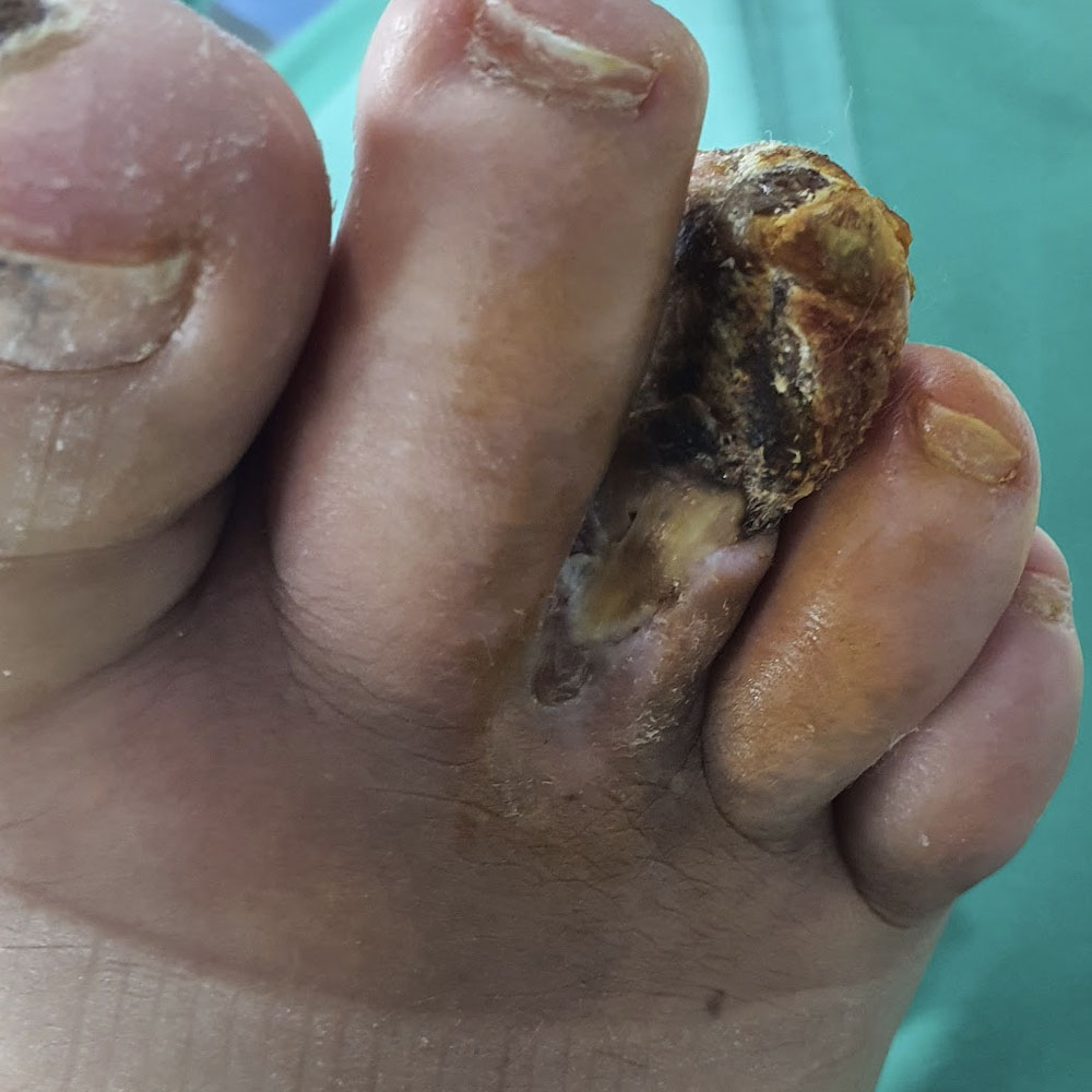 Third Ray Amputation After Revascularization before image