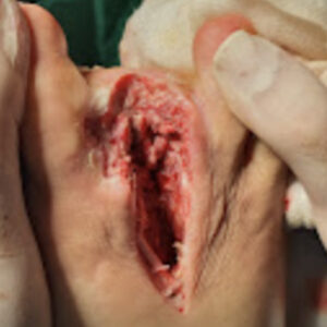 Third Ray Amputation After Revascularization procedure image