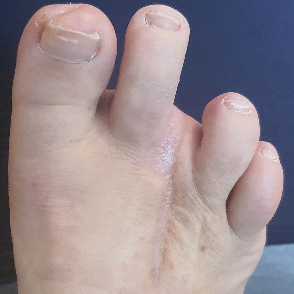 Third Ray Amputation After Revascularization outcome image