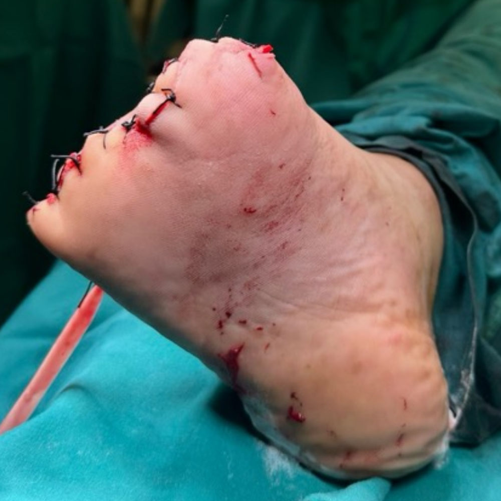 Transmetatarsal Amputation Following Successful Revascularization procedure image