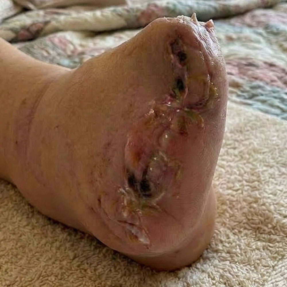 Transmetatarsal Amputation Following Successful Revascularization outcome image