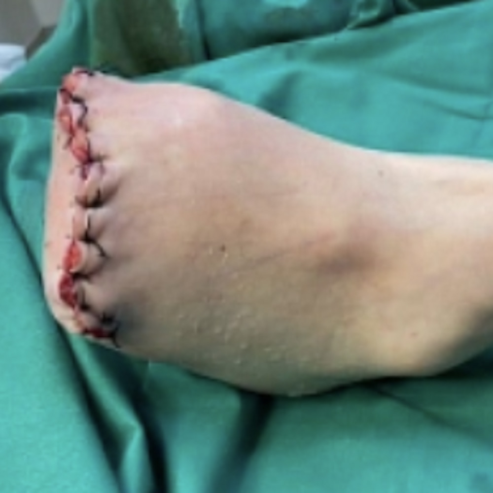 Transmetatarsal Amputation for Forefoot Ischemic Gangrene procedure image