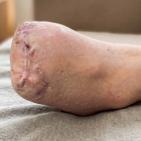 Transmetatarsal Amputation for Forefoot Ischemic Gangrene outcome image