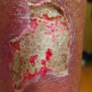 Traumatic Lower Leg Wound before image