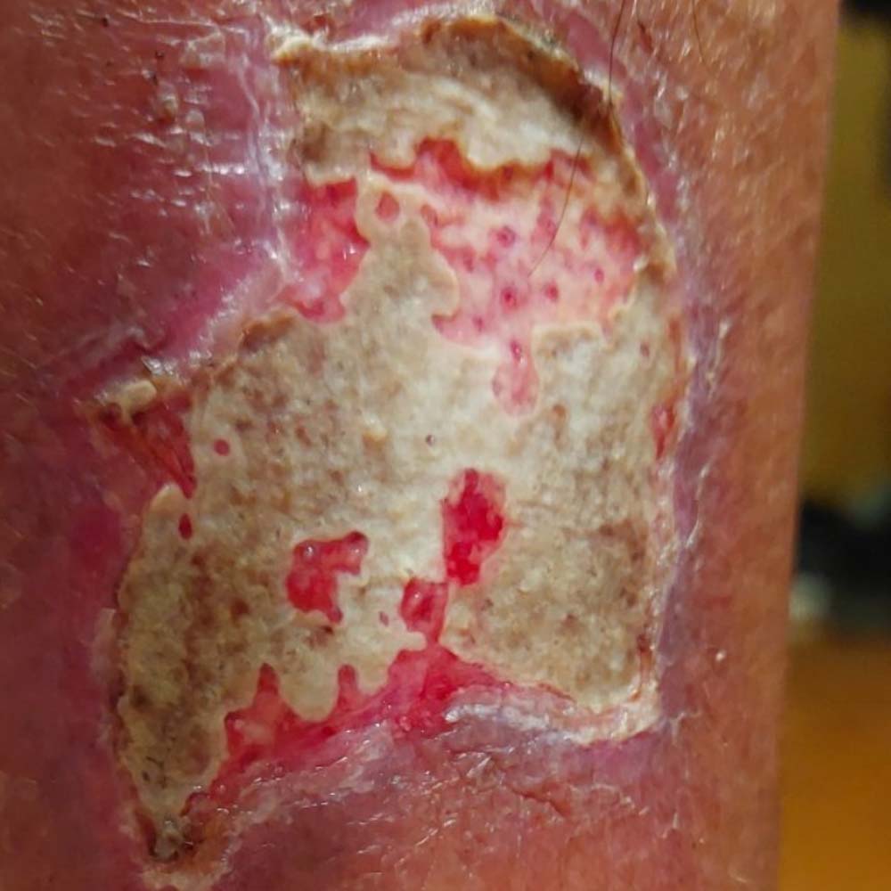 Traumatic Lower Leg Wound before image