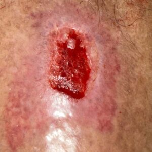 Traumatic Lower Leg Wound procedure image
