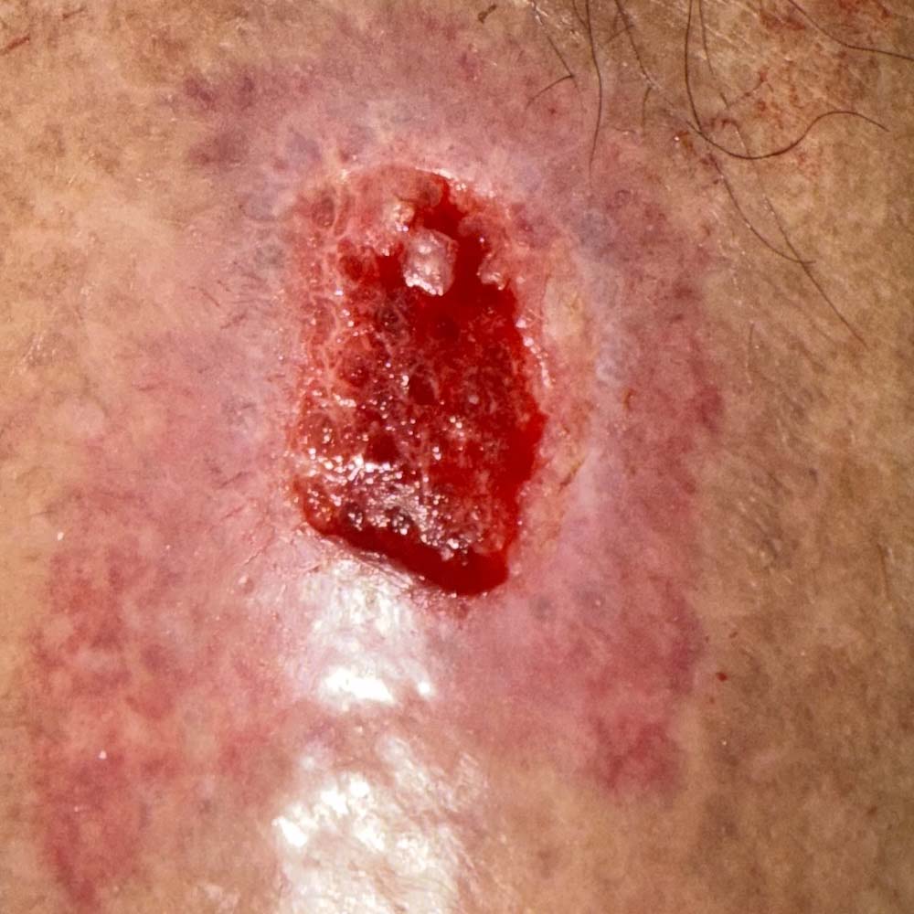 Traumatic Lower Leg Wound procedure image