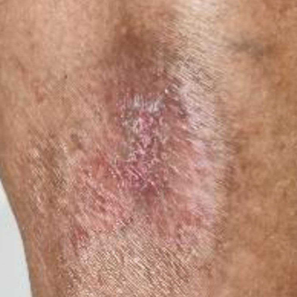 Traumatic Lower Leg Wound outcome image